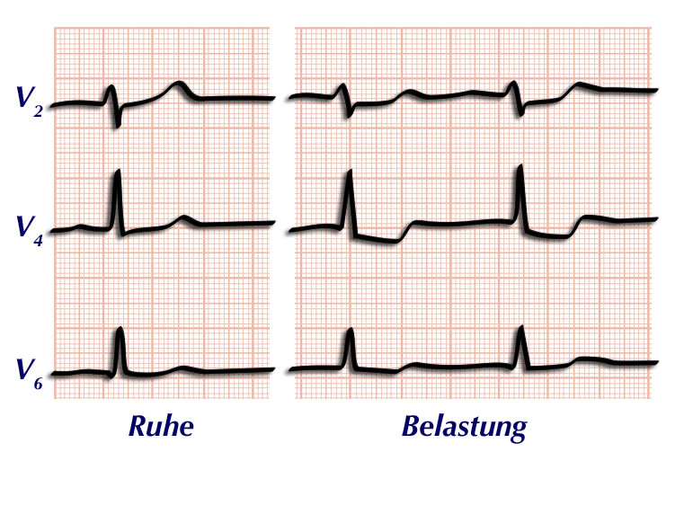 Wieviel Watt Sollte Man Beim Belastungs Ekg Schaffen www.meinherzdeinherz.info
