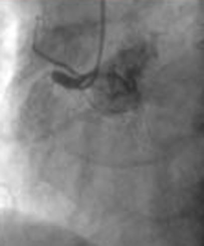 stent setzen ablauf