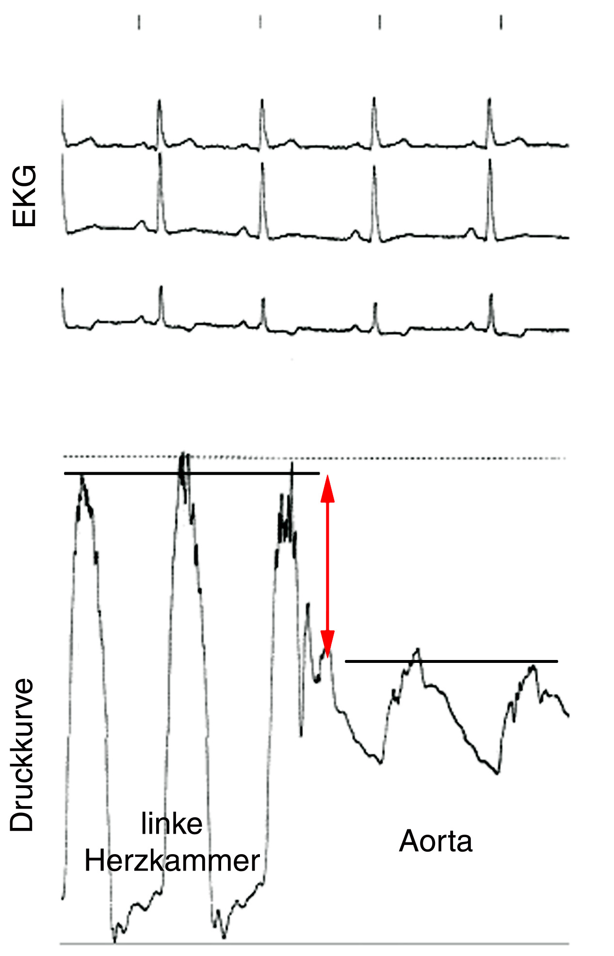 Aortenstenose Druck