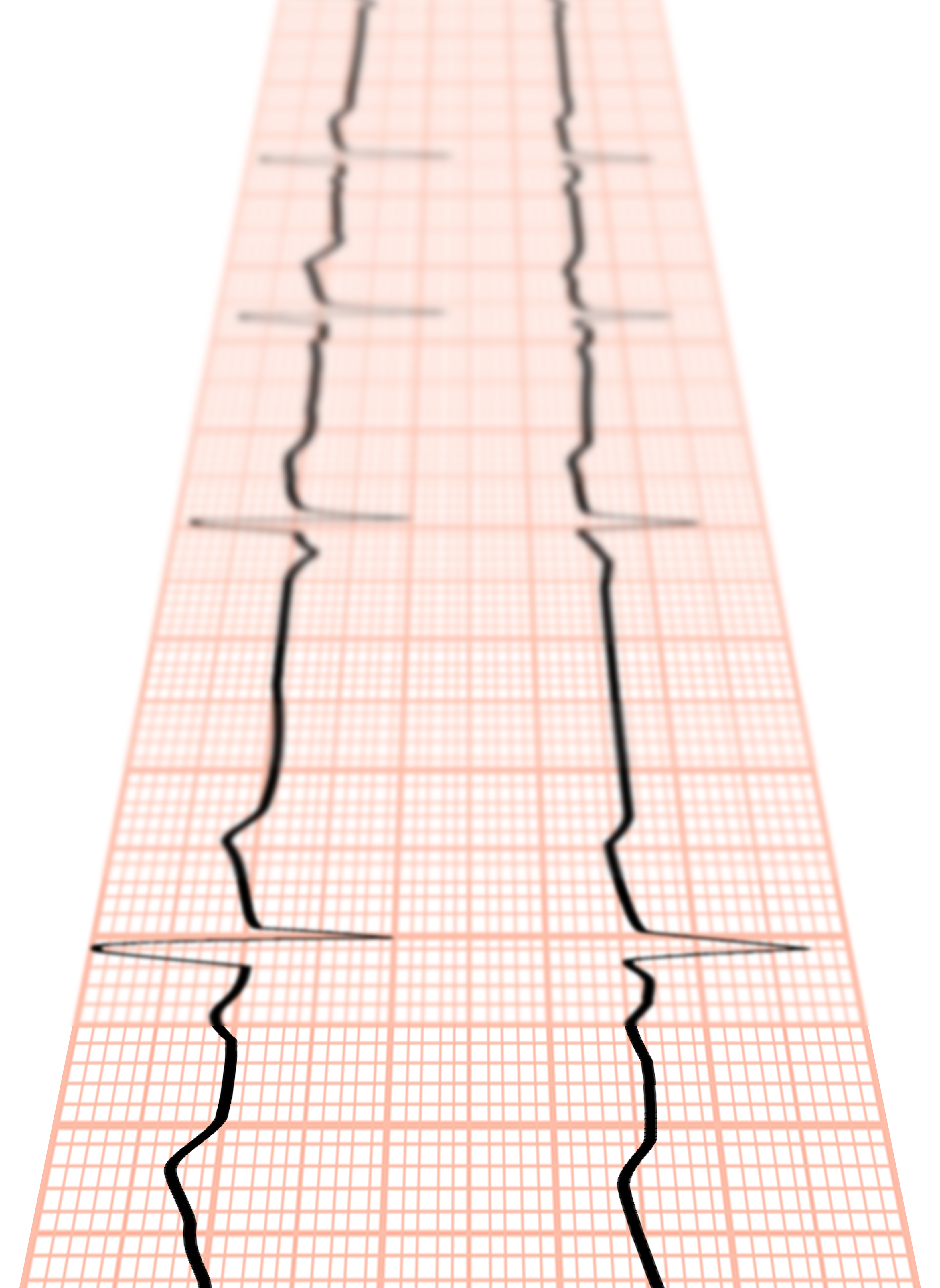 EKG