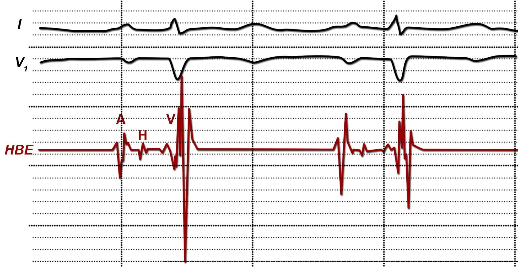 HIS-Bündel-EKG