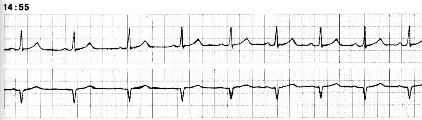 Langzeit-EKG normal