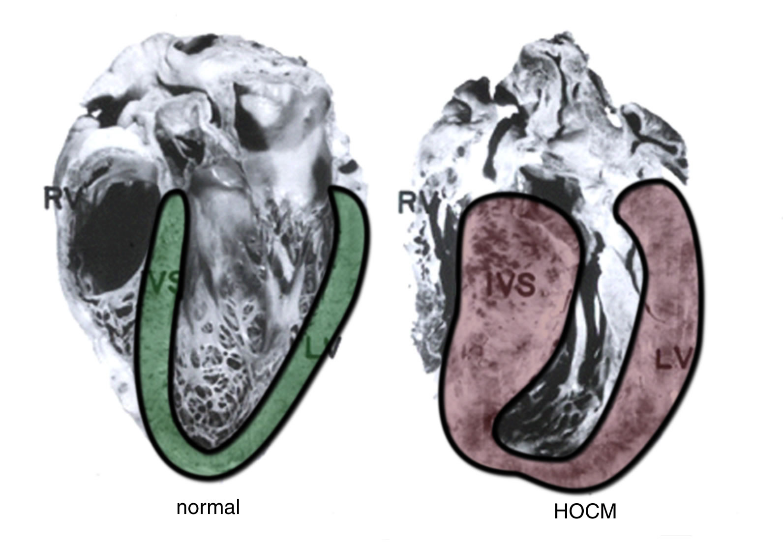 HOCM-Pathologie