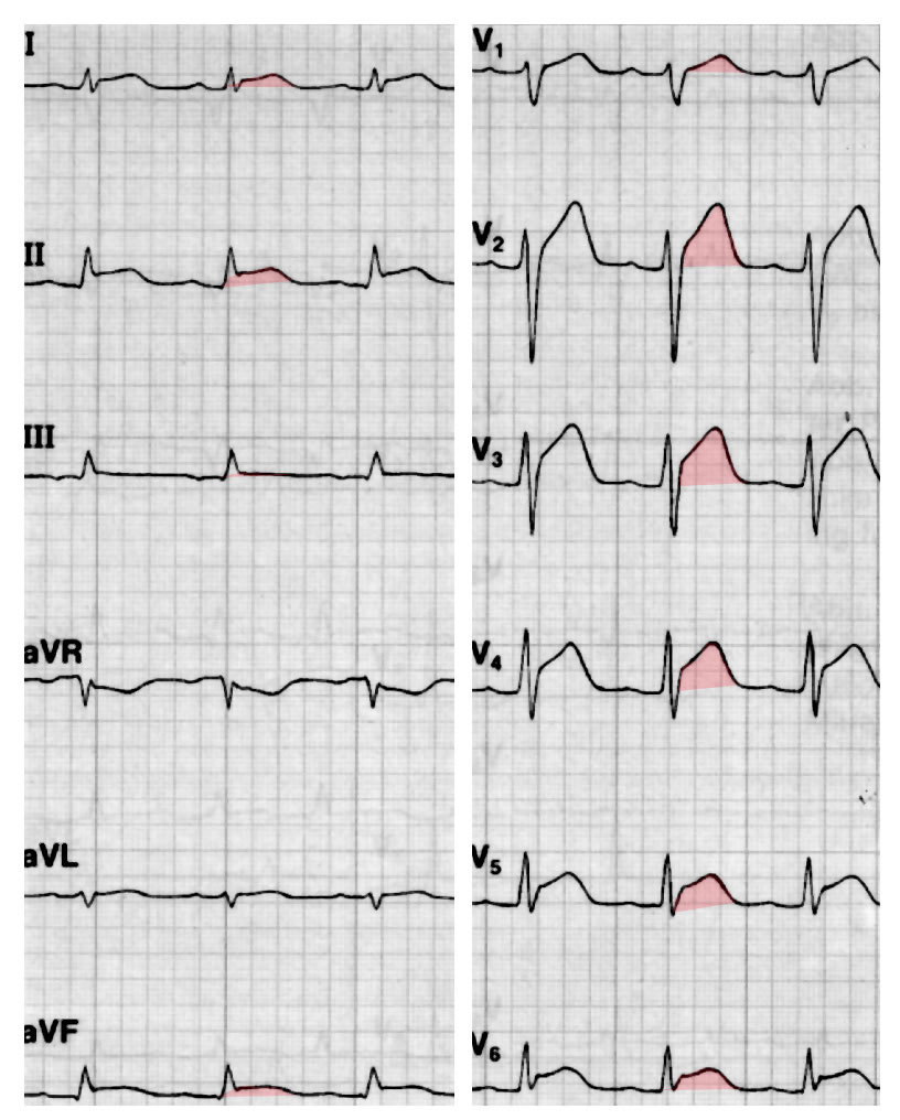 EKG