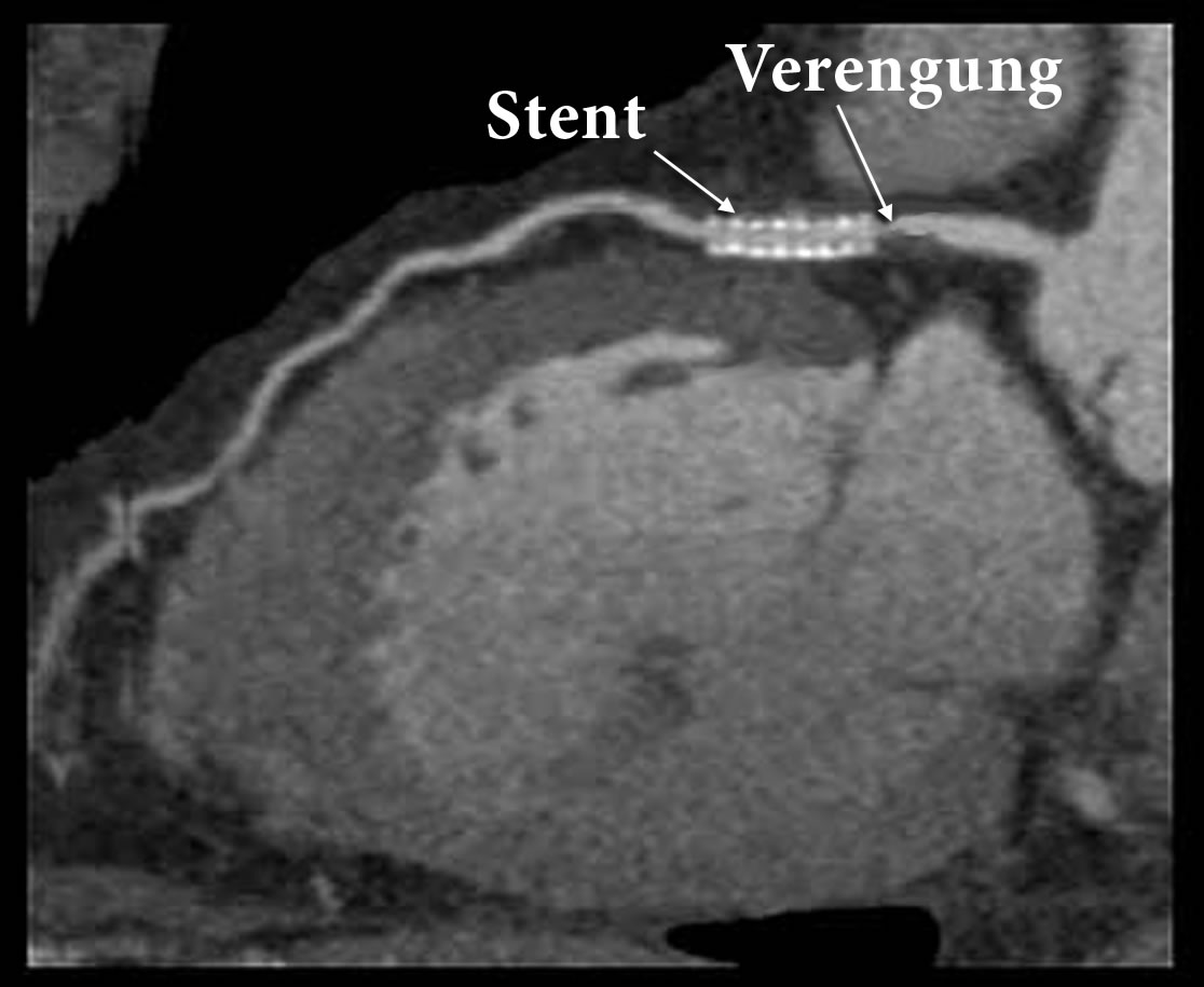 Stent