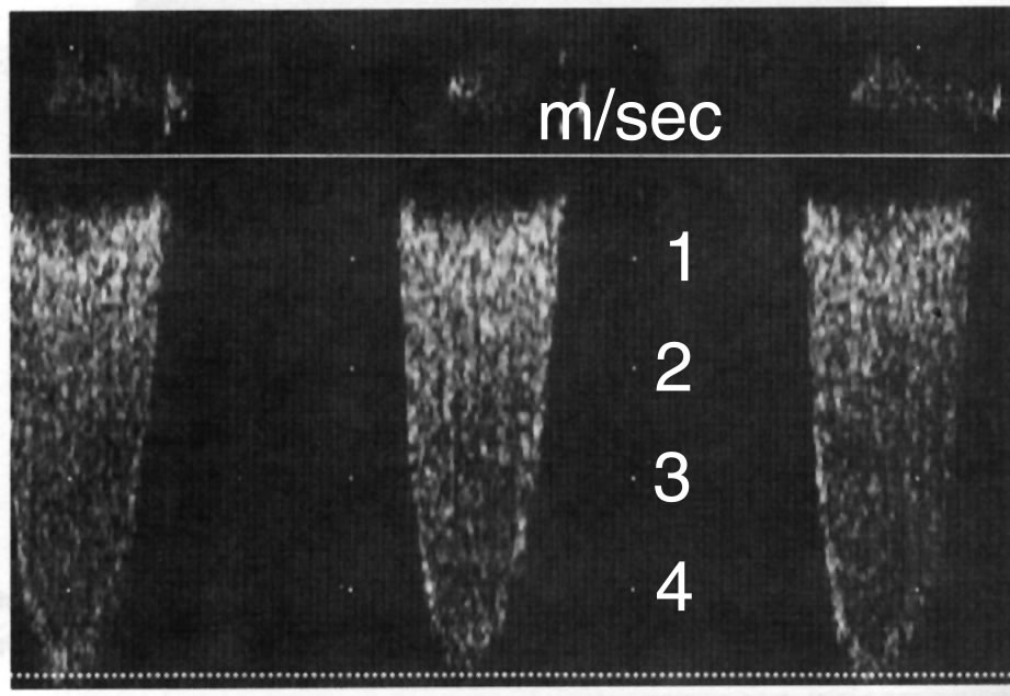 Aortenklappenstenose im cw-Doppler