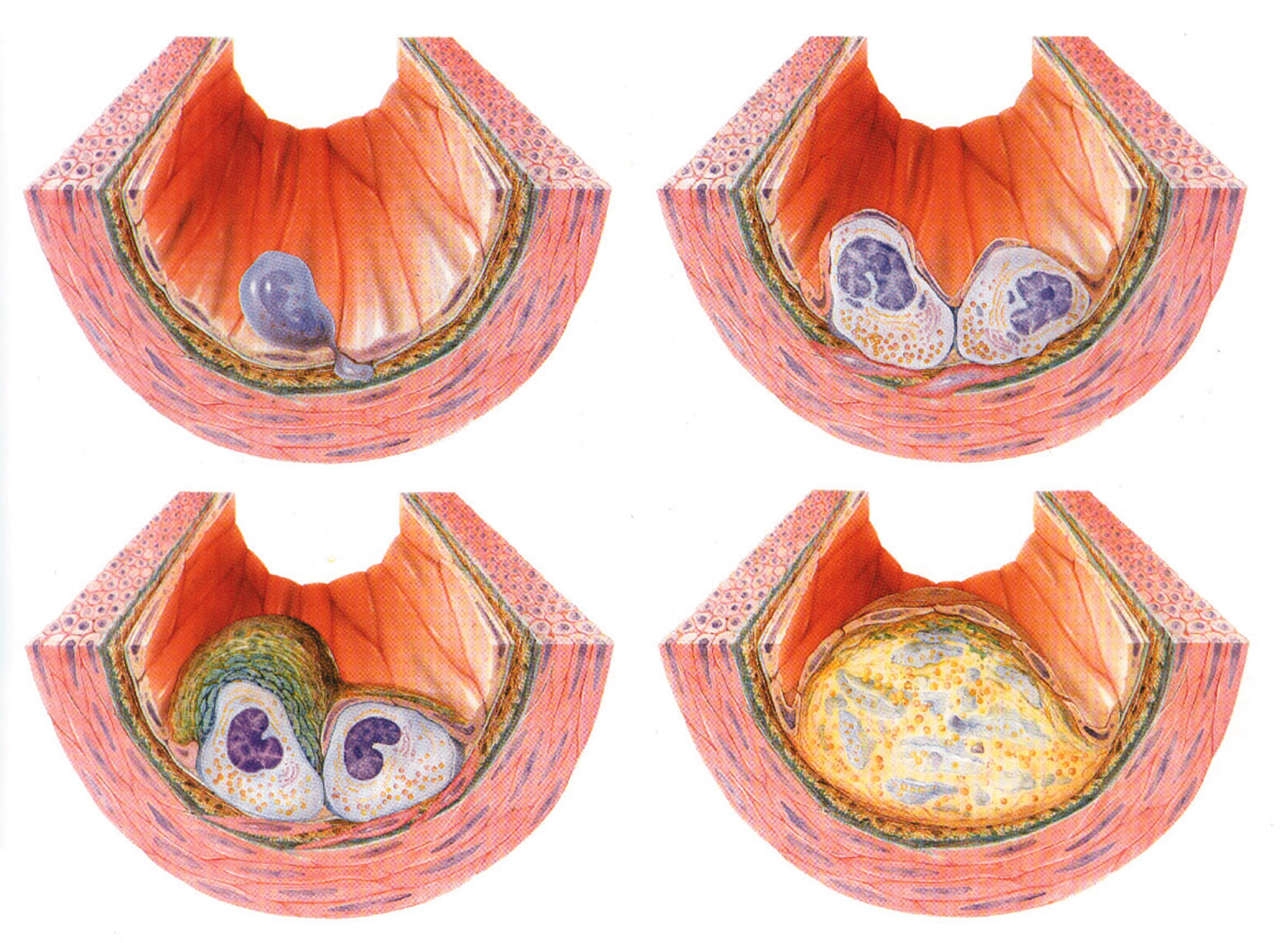 Arteriosklerose