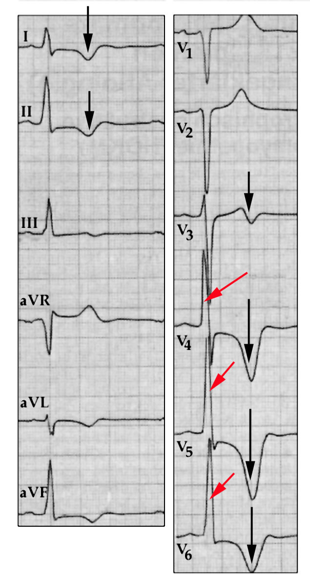 HOCM EKG