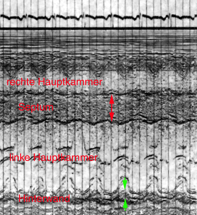 HOCM im Echo