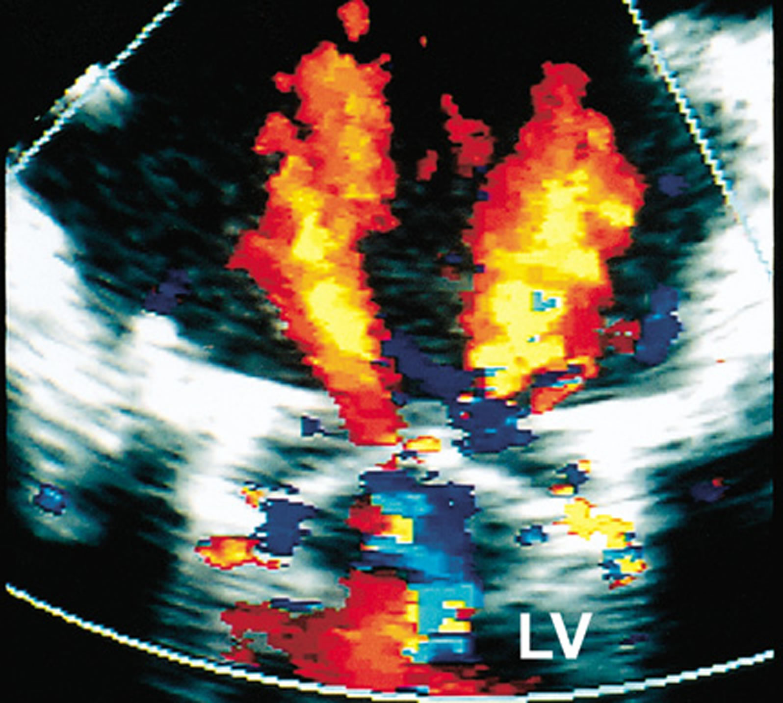 Mitralprothese im Farbdoppler