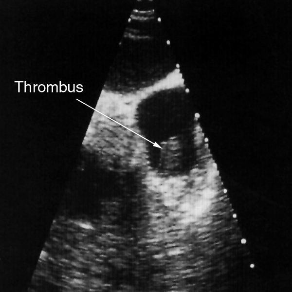 Thrombus