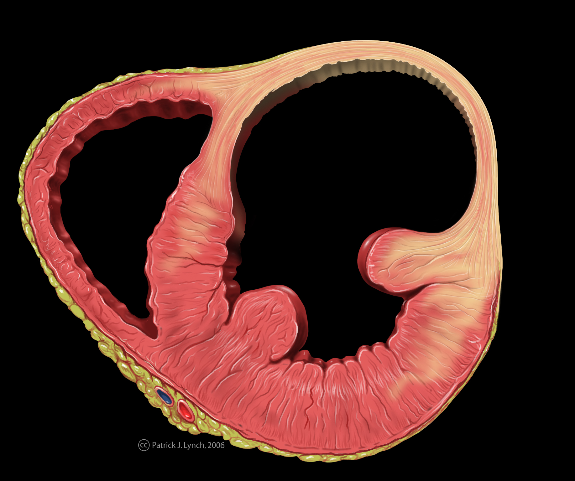 Aneurysma