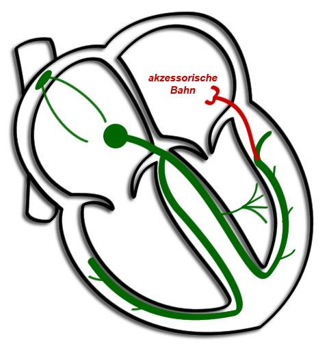 WPW-Bahn