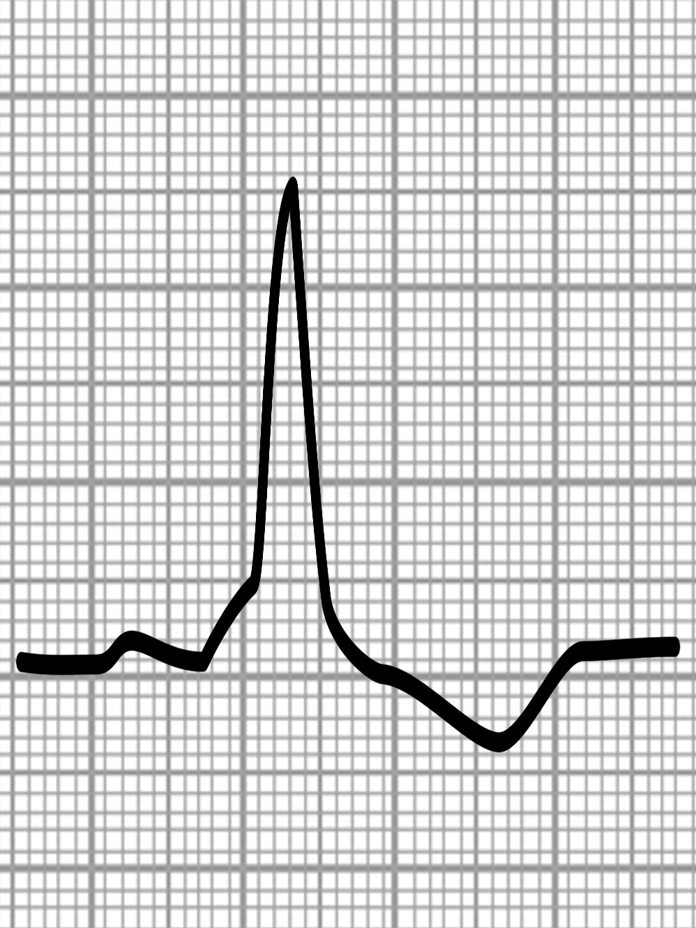 WPW-EKG