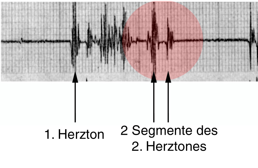 gespaltene Herztöne