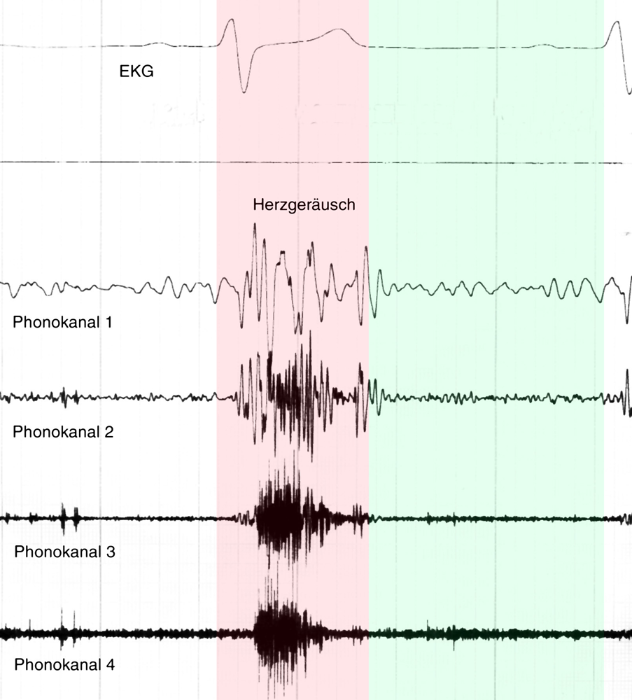 systolisches Ger#usch